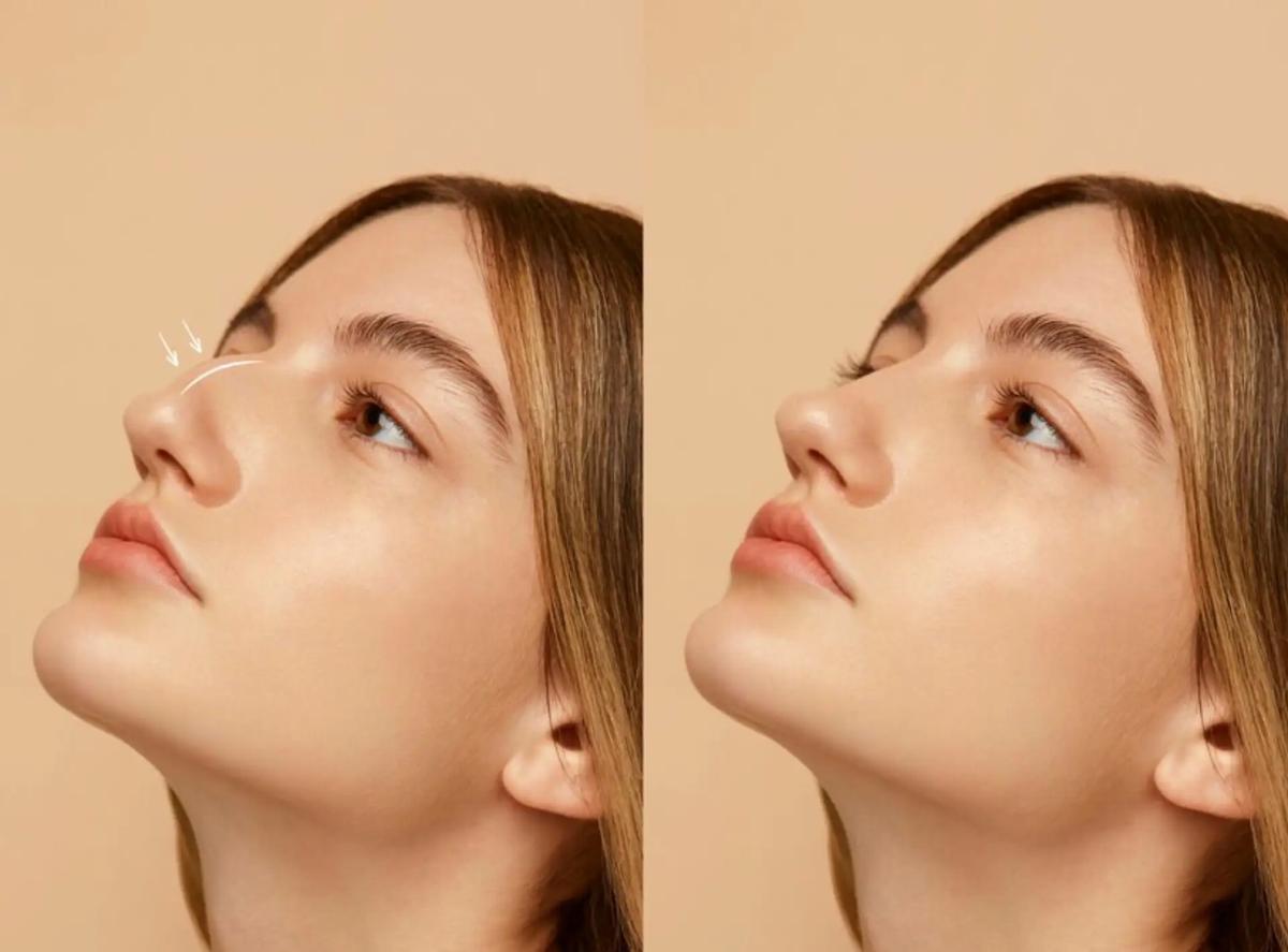 Is Rhinoplasty in Dubai Worth It? Here’s What You Need to Know